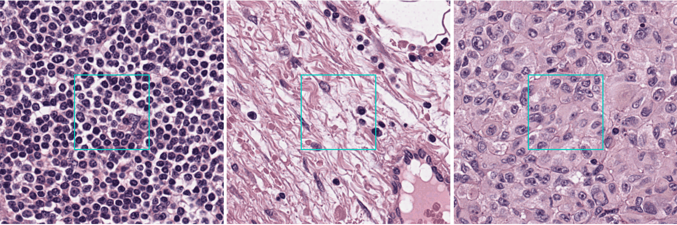 Three squares of the same slide at full resolution, left to right: the node's own lymphoid tissue; the collagen of the capsule and the septa; the deposit that has replaced the node's own tissue. The one tile at the centre of each is outlined.
